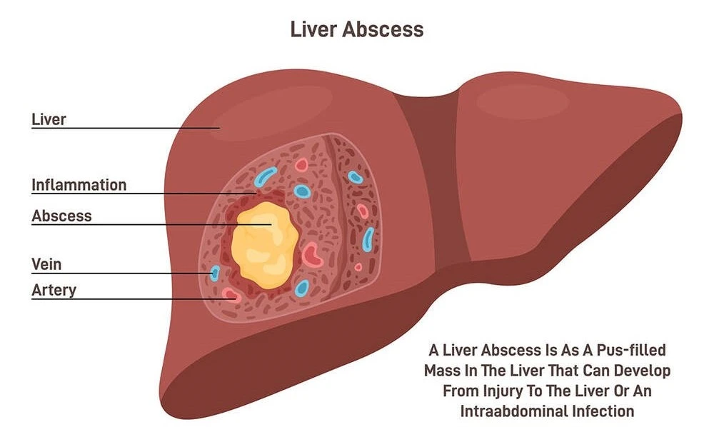 What Is Liver Abscess and Why Drainage Is Needed